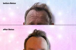 forehead botox for men
