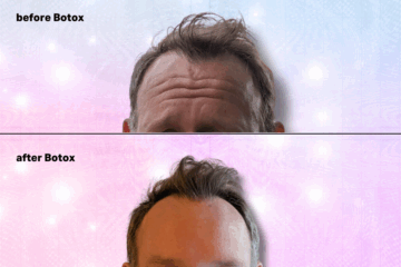 What Are You Waiting For? Go Get Botox In Your Forehead